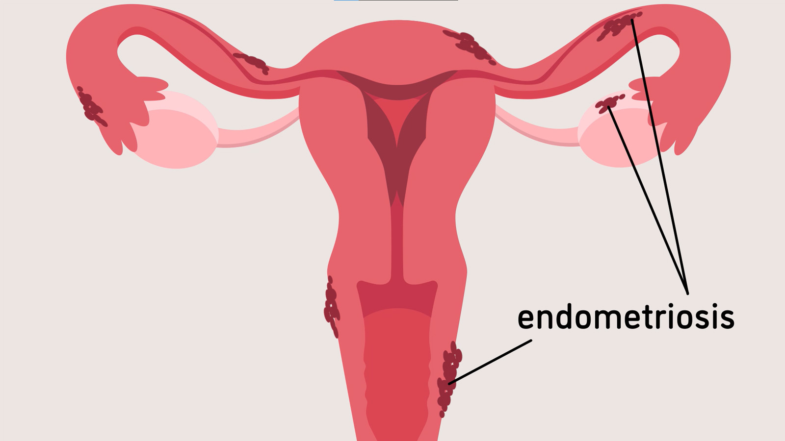 Março Amarelo: Conscientização Mundial da Endometriose